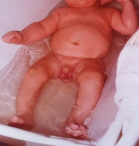 Adherencias en niños y bebes, parafimosis en niños y bebes, problemas en el pene en niños y bebes, fimosis en niños y bebes, cirugía infantil