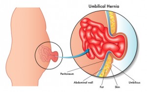 hernia umbilical en bebes, hernia umbilical en recién nacidos tratamiento de la hernia  umbilical en bebes, hernia umbilical en niñas, cuando operar las hernias umbilicales en niños y bebes