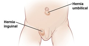 hernias en bebes y niños, bultos en la ingle en bebes y niños, bulto en la ingle doloroso