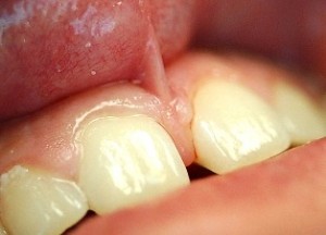frenillo del labio superior en bebes y niños, frenillo labial superior en bebes y niños, diastema en bebes y niños, frenillos en la boca de bebes y niños