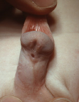 Hipospadias en niños y bebes, tipos de hipospadias en niños, síntomas de la hipospadias en niños