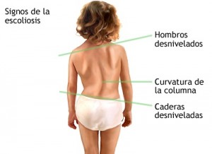 escoliosis en niños y adolescentes, tratamiento de la escoliosis, escoliosis en niños pequeños
