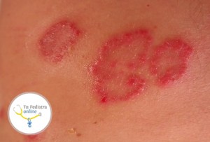 causas de la psoriasis, psoriasis en niños, psoriasis en adolescentes