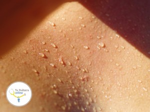 sudoración excesiva en niños, sudoración nocturna, transpiración excesiva niños, trastornos del sudor niños, tratamiento hiperhidrosis, tratamiento sudoración excesiva