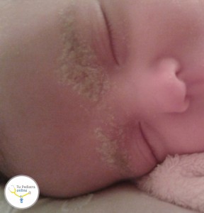 costar lacteal, dermatitis seborreica, lactante, láctea, cabeza del bebé, caspa bebé, champú costra láctea, champú dermatitis seborreica, costra láctea bebé