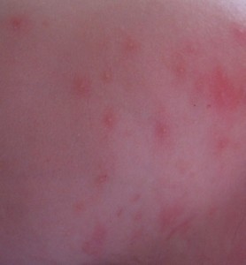 1. eritema tóxico (1)