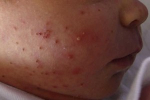 2. melanosis pustulosa (1)