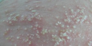 4. pustulosis benigna cefalica