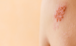 informacion sobre el herpes zoster de TuPediatraOnline