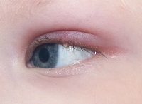 Barley, hordeolum in a child. Purulent pouch on the boy's eye