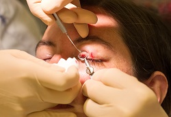 Healthcare concept - Chalazion during eye examination and operat