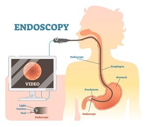 endoscopia