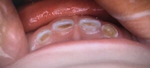 caries evolucionada primera infancia tupediatraonline