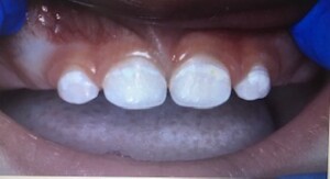 caries primera infancia mancha blanca tupediatraonline