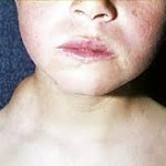 pediatra en linea adenopatias en niños y bebes