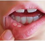 aftas en niños y bebes pediatra en linea