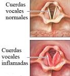 cuerdas vocales niños y bebes pediatra en linea