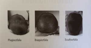 deformidades-craneales