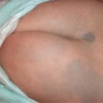 Son marcas cutáneas planas, de color azul o azul-grisáceo cerca de los glúteos que se descubren al nacimiento o poco después Son comunes en aquellas personas de ascendencia asiática, africana o del este de la India por ello se llaman machas mongoloides, nombre que suele asustar a los padres. No están asociadas a ninguna enfermedad y pueden llegar a cubrir una  parte importante de la espalda. A veces se confunden con hematomas sobre todo en el caso de sospechas de maltrato infantil pero estas son de nacimiento. Las podemos definir como: •	Manchas azules o azul-grisáceas en la espalda, los glúteos, base de la columna, hombros y también pueden encontrarse en otras zonas del cuerpo. •	Son planas, de bordes mal definidos y formas irregulares. •	La textura de la piel no cambial. •	El diámetro puede ser de  2 a 8 cm.  El pediatra puede diagnosticar esta característica  al examinar la piel del recién nacido y no precisa de más pruebas .No precisan tratamiento alguno ya que las manchas suelen desaparecer con los años, manchas mongolicas