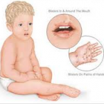 virus boca mano pie en niños y bebés